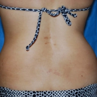 Before Procedure