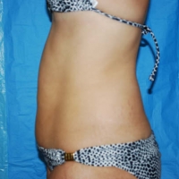 Before Procedure