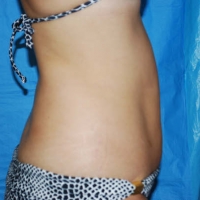 Before Procedure