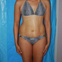 Before Procedure