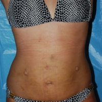 smartlipo008