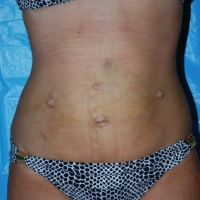 smartlipo009