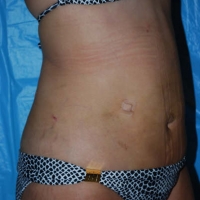 smartlipo010