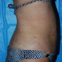 smartlipo011