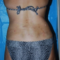 smartlipo012