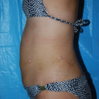 smartlipo014