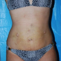 smartlipo016