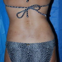 smartlipo020