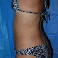 smartlipo021