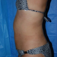 smartlipo022