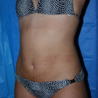 smartlipo023