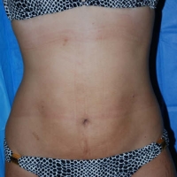 smartlipo025