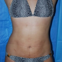 smartlipo026