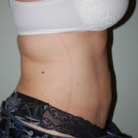 20ar-post-lipo-1