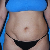 10ar-pre-lipo-1