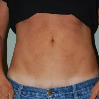 20ge-post-lipo-1