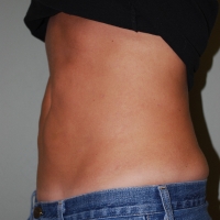 21ge-post-lipo-2