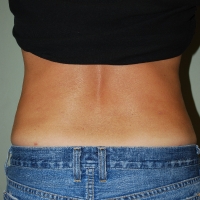 22ge-post-lipo-3