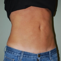 23ge-post-lipo-4