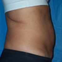 12ge-pre-lipo-3