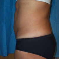 14ge-pre-lipo-5