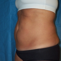 15ge-pre-lipo-6