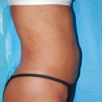 20after-lipo-6