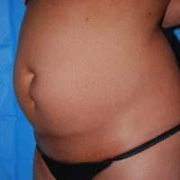 11smart-lipo-pre-007