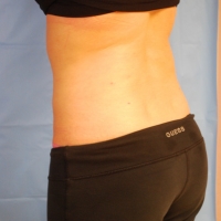 15after-smartlipo-008